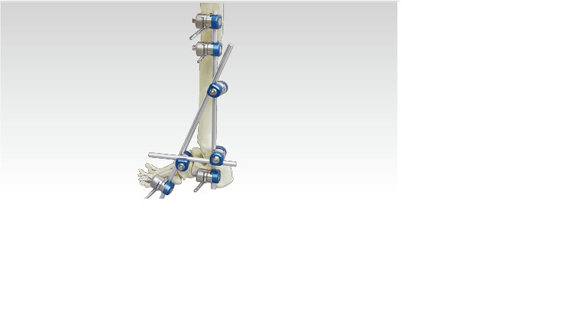 Hoffman external fixation bracket