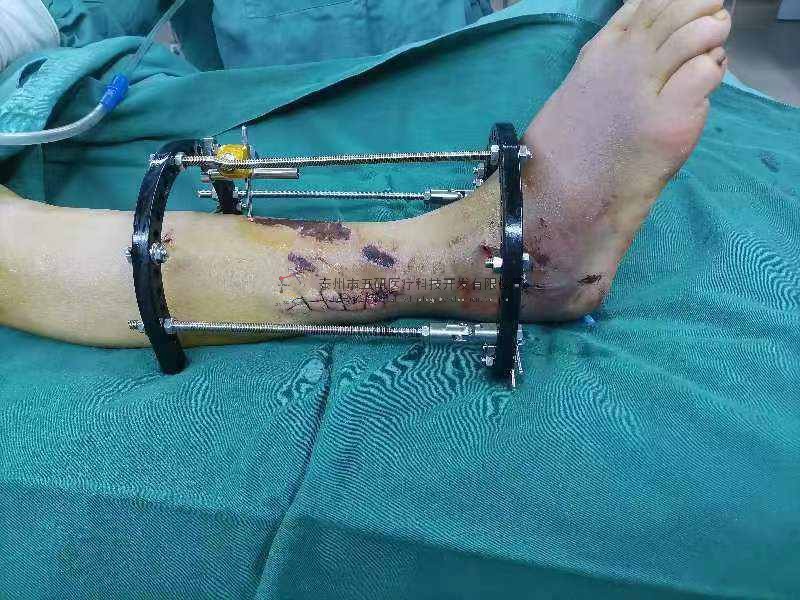 病例分享——踝关节粉碎性骨折（PILONG骨折）（糖尿病➕局部皮肤条件差）