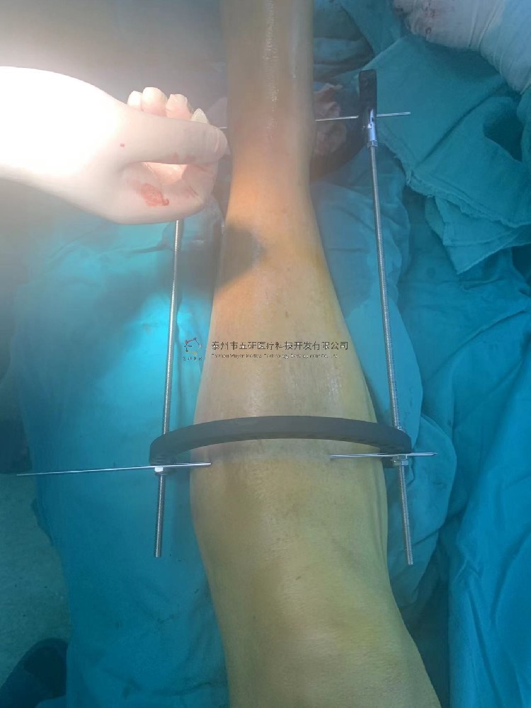【望京医院】不开刀治骨折——CO接骨架典型病例分享