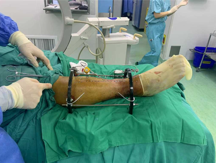 【望京医院】不开刀治骨折病例分享——小腿骨折伴踝骨折