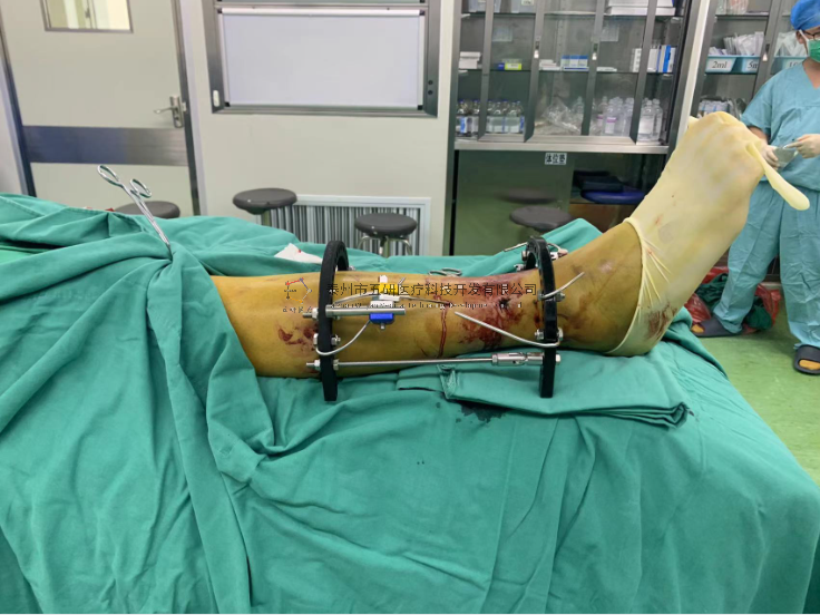 【望京医院】不开刀治骨折病例分享——右胫骨远端骨折