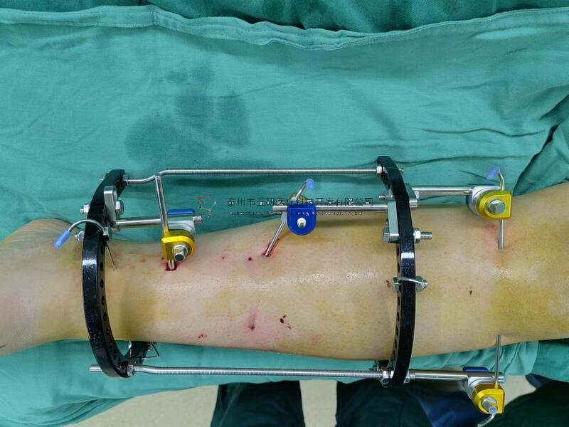 【南阳市中医院】不开刀治骨折病例分享