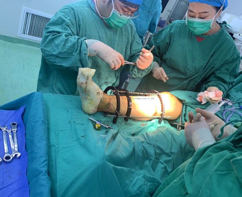 【望京医院】不开刀治骨折病例分享——胫骨远端骨折腓骨骨折